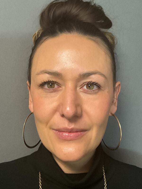 Before & After Dermal Fillers Fort Collins Harmony Skin & Wellness