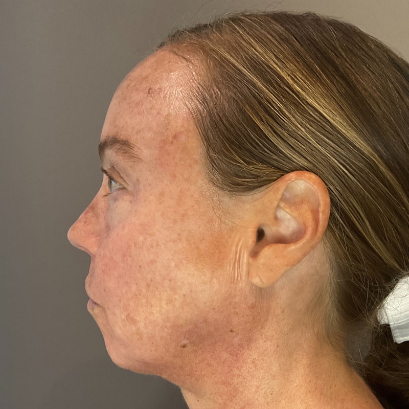 IPL Photofacial Fort Collins Harmony Skin & Wellness Clinic