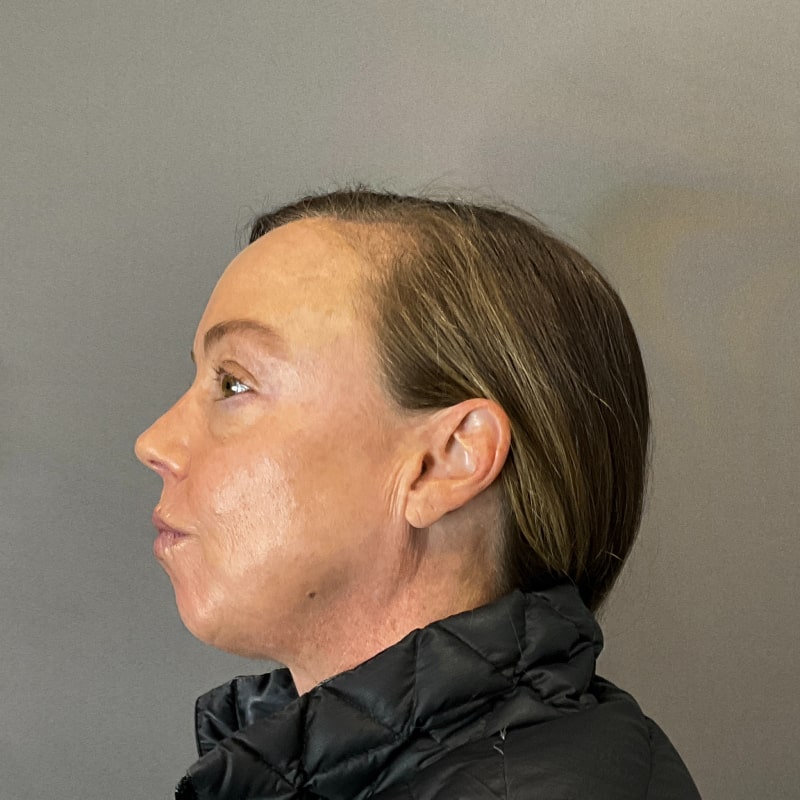 IPL Photofacial Fort Collins Harmony Skin & Wellness Clinic