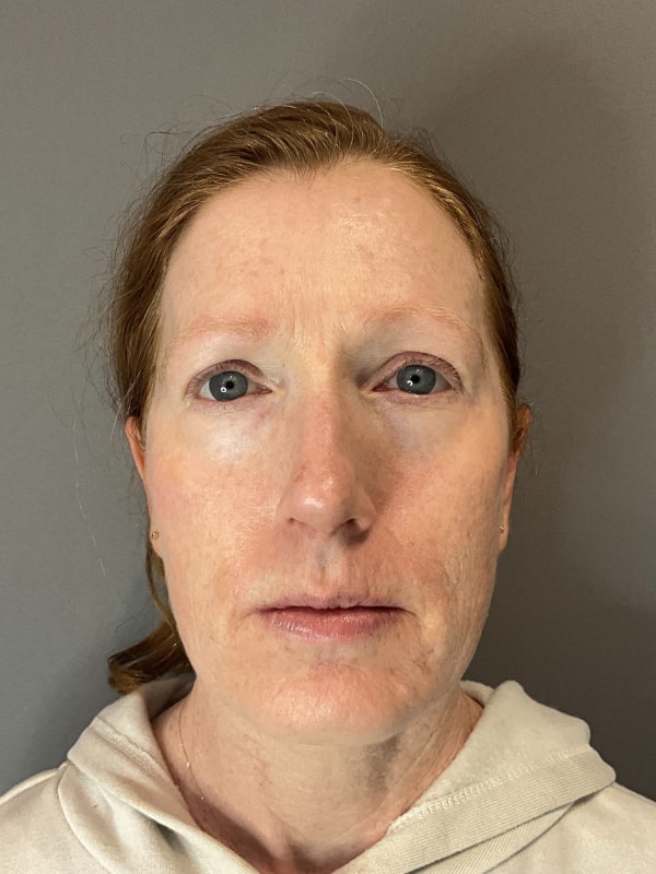 IPL Photofacial Fort Collins Harmony Skin & Wellness Clinic