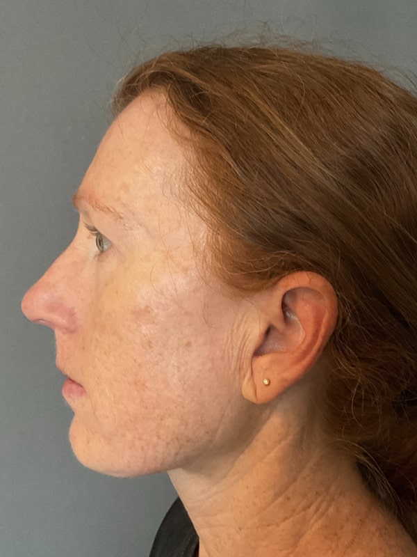 IPL Photofacial Fort Collins Harmony Skin & Wellness Clinic