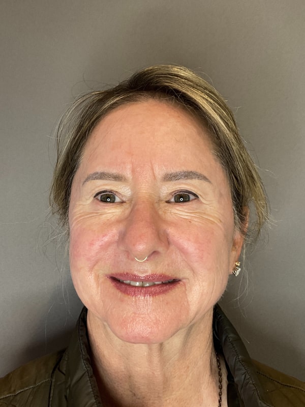 Laser Skin Resurfacing Fort Collins Harmony Skin & Wellness Clinic