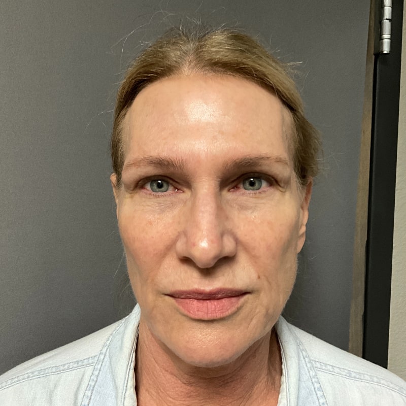 Ultherapy Fort Collins Harmony Skin & Wellness Clinic