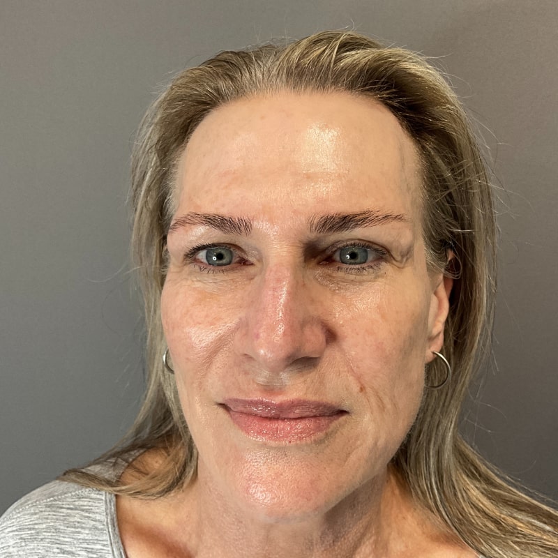 Ultherapy Fort Collins Harmony Skin & Wellness Clinic