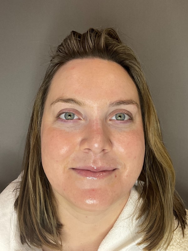 Before & After Microneedling Fort Collins Harmony Skin & Wellness